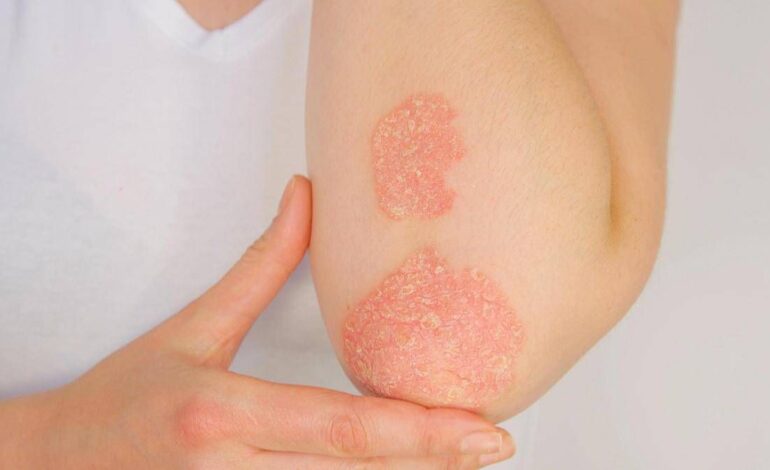 Giornata psoriasi, Ucb rinnova l’impegno contro lo stigma