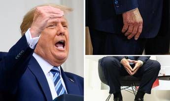  Trump e le gambe gonfie, cos’è l’insufficienza venosa cronica