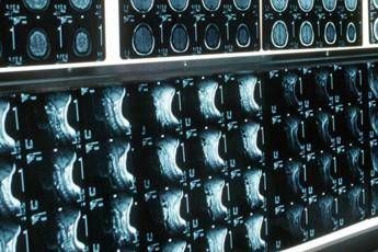 Ipofosfatemia legata all’X, primo bilancio e prospettive su linee guida